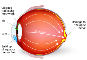 glaucoma-300x207